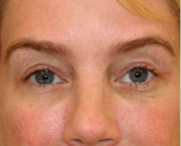 Feel Beautiful - Blepharoplasty Upper Eyelids 104 - After Photo